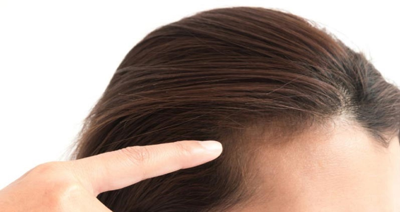 ریزش موی هورمونی - درمان ریزش مو