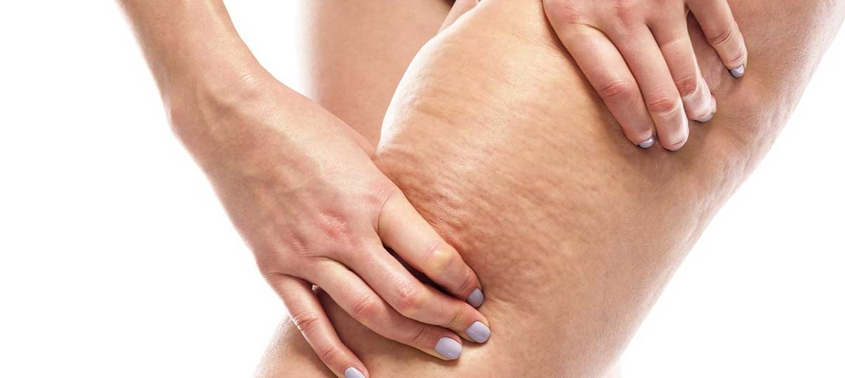 سلولیت ران - درمان سلولیت پوست