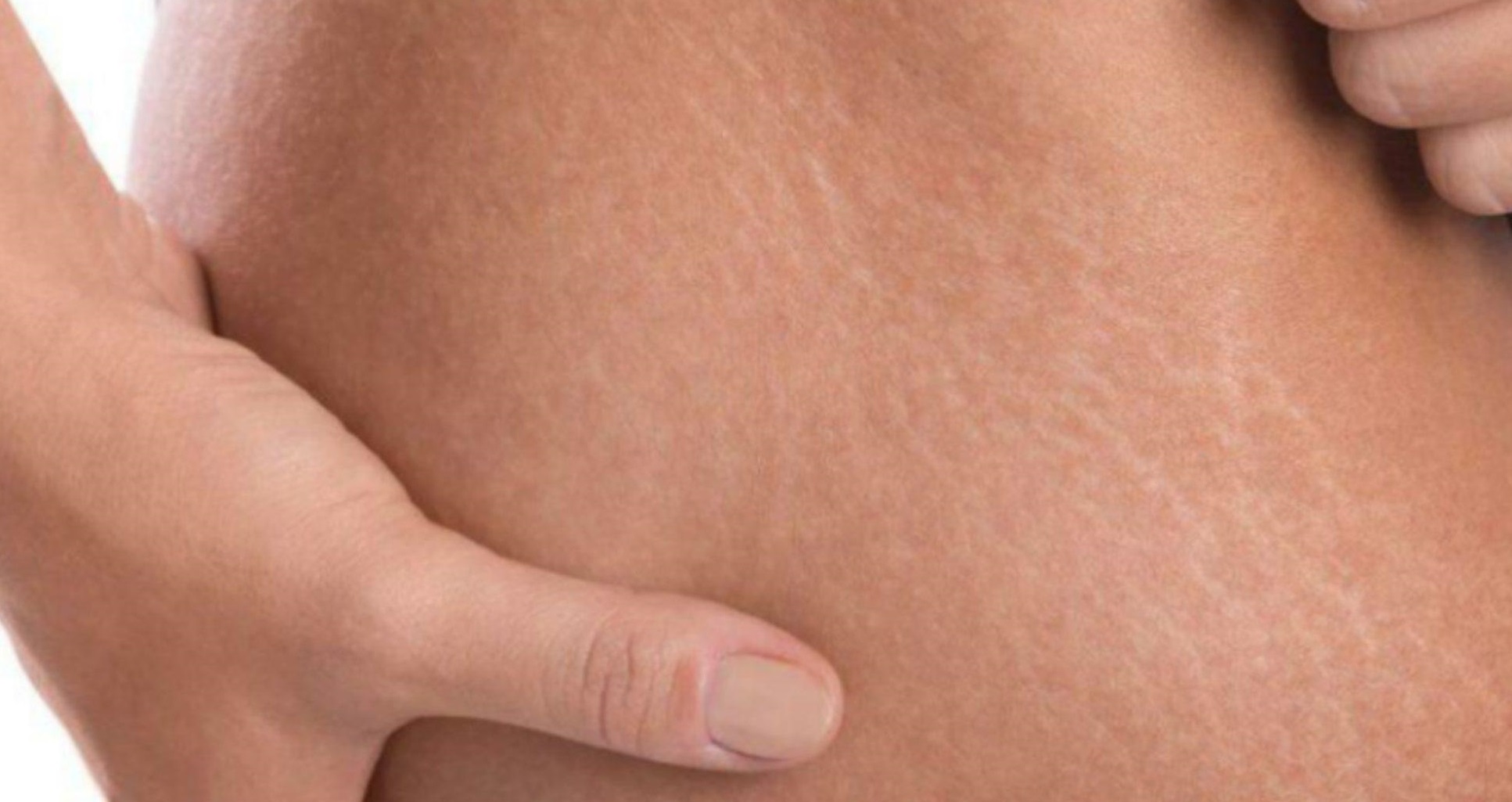 سلولیت پا - درمان سلولیت پوست