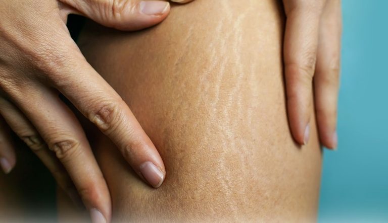 درمان سلولیت پوست