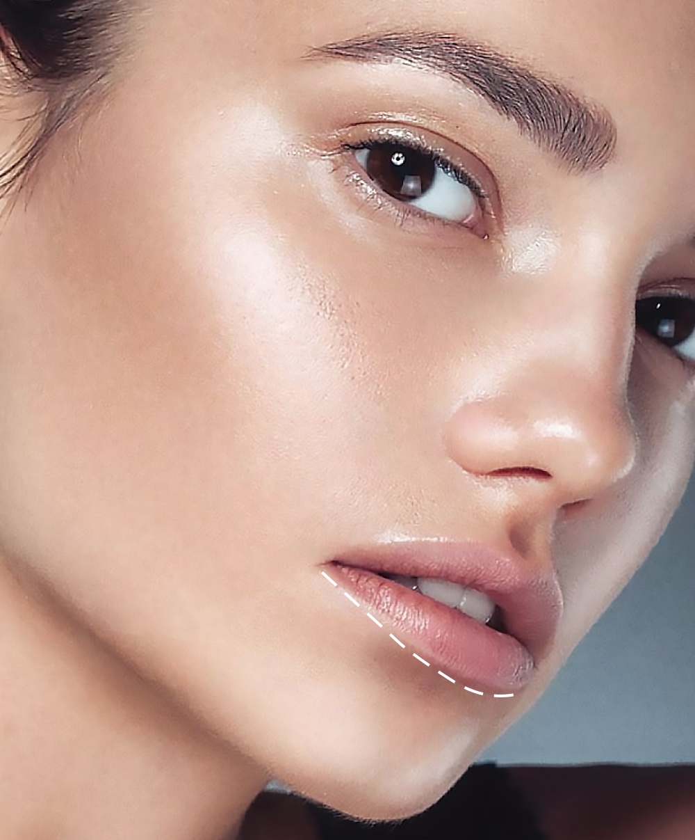 جراحی زیبایی - برجسته کردن لب