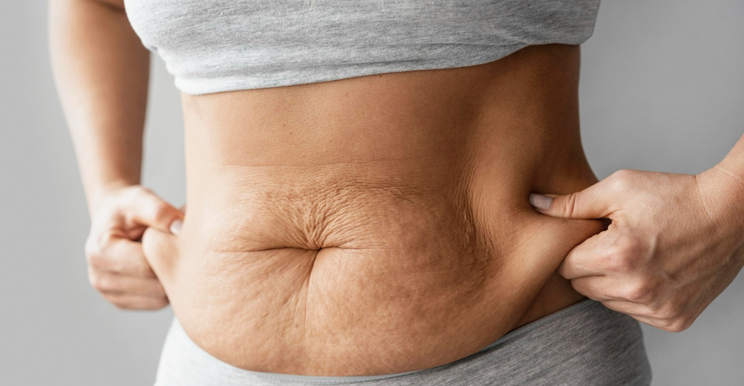 سلولیت حاملگی - درمان سلولیت پوست