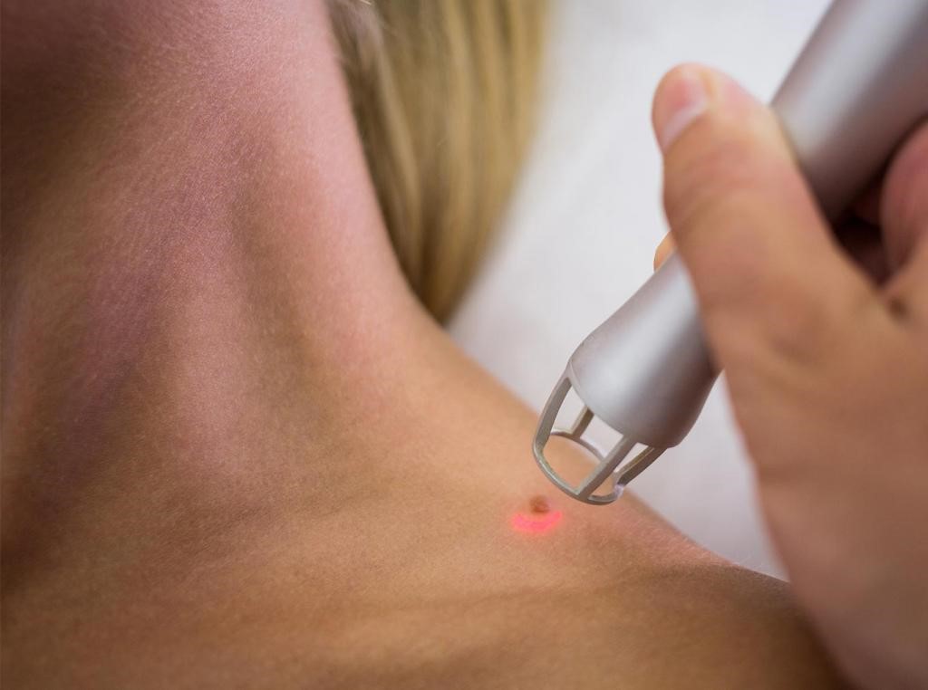 درمان منگوله پوستی با لیزر - زائده گوشتی روی پوست