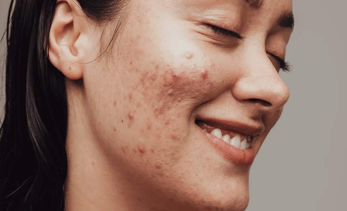 درمان جوش صورت - کلخنگ برای لک صورت