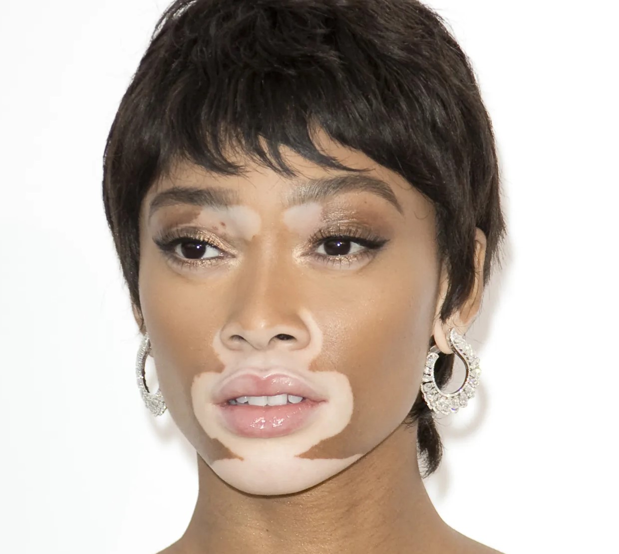 عارضه پوستی - انواع لکه های پوستی