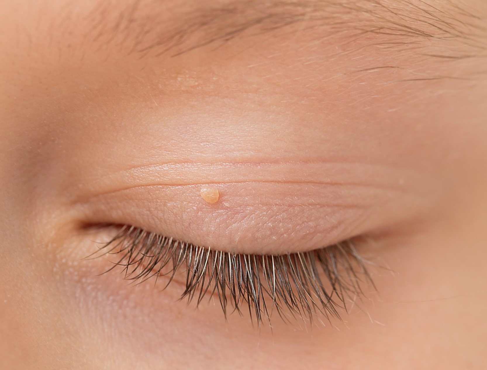خال گوشتی پشت پلک - زائده گوشتی روی پوست