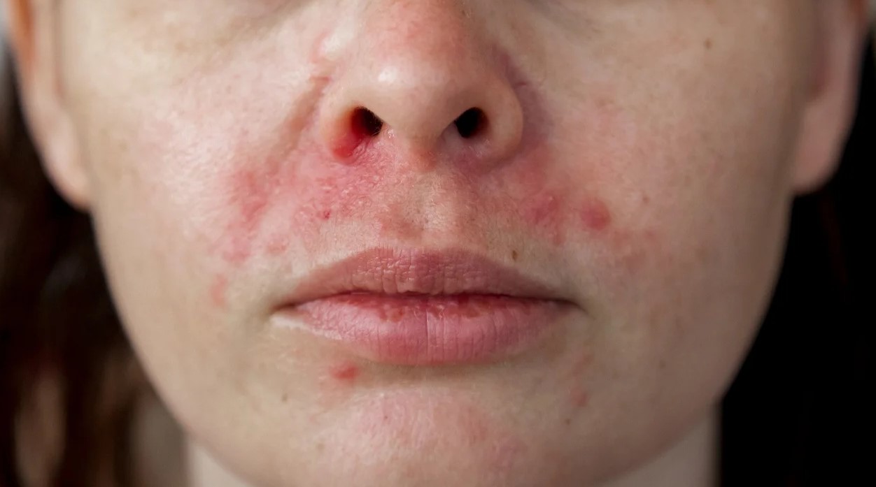 حساسیت پوستی - انواع لکه های پوستی