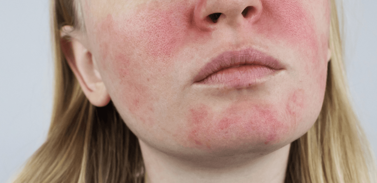 قرمزی صورت - انواع لکه های پوستی