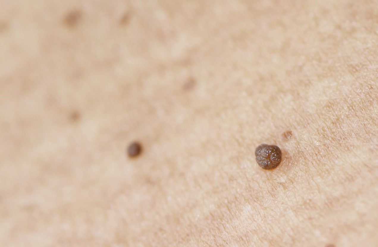 خال گوشتی روی گردن - زائده گوشتی روی پوست