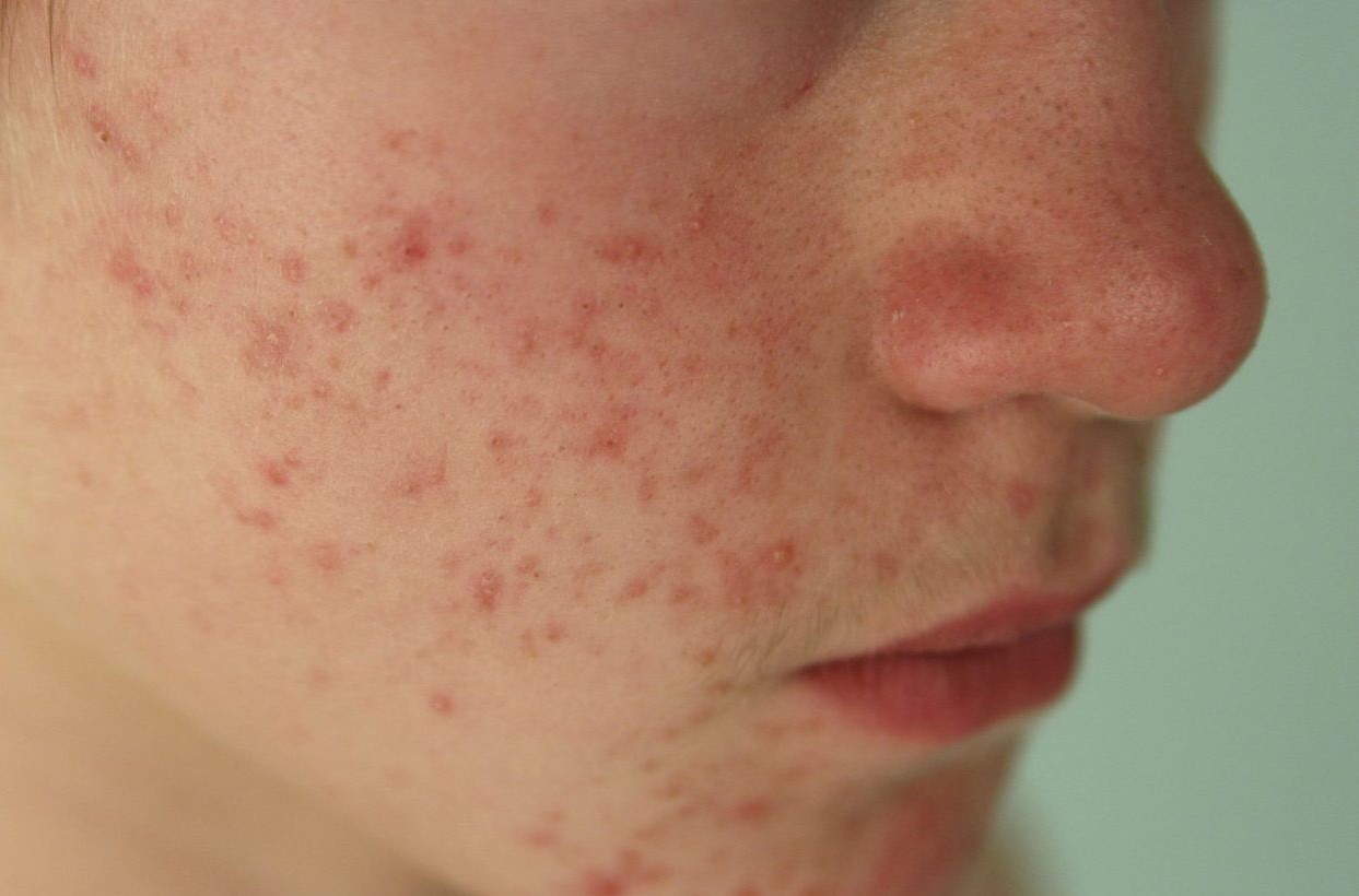 لکه های قرمز صورت - انواع لکه های پوستی