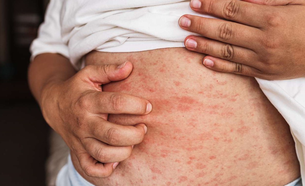 اسکار - انواع لکه های پوستی