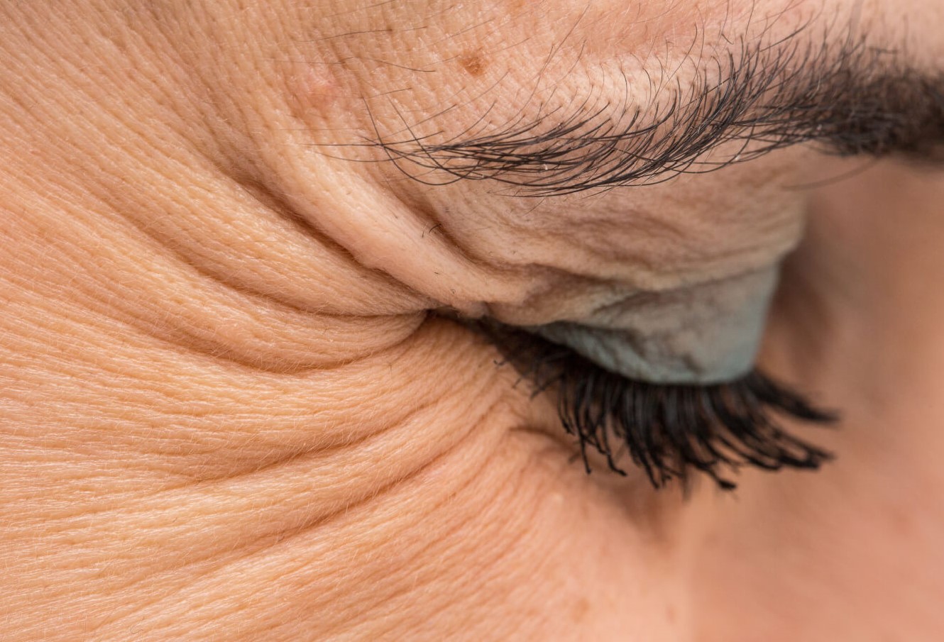 چروک دور چشم - کرم رفع چروک پنجه کلاغی