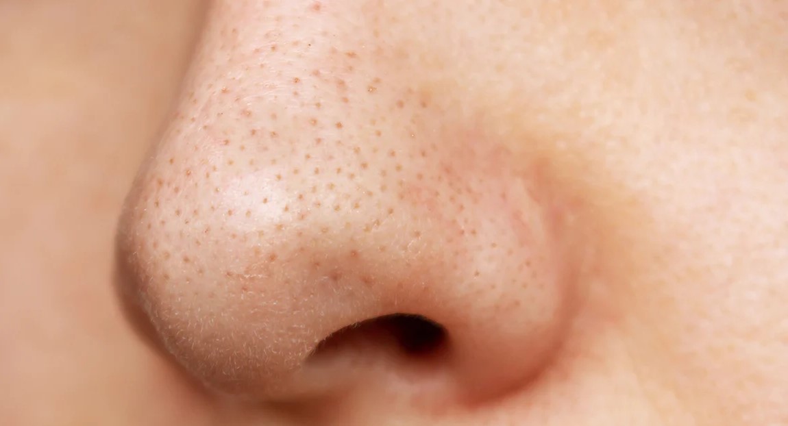 جوش های سرسیاه بینی - روتین پوست چرب و منافذ باز