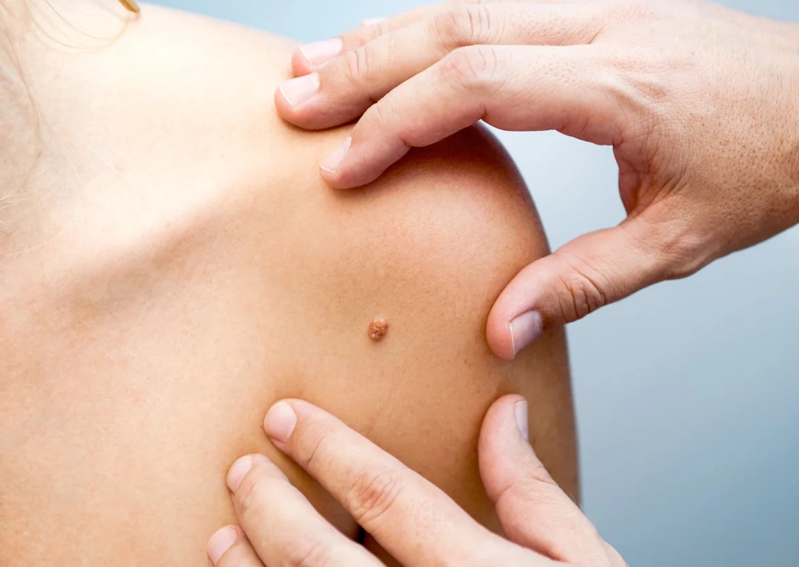 روش های خانگی زگیل پوستی - زائده گوشتی روی پوست