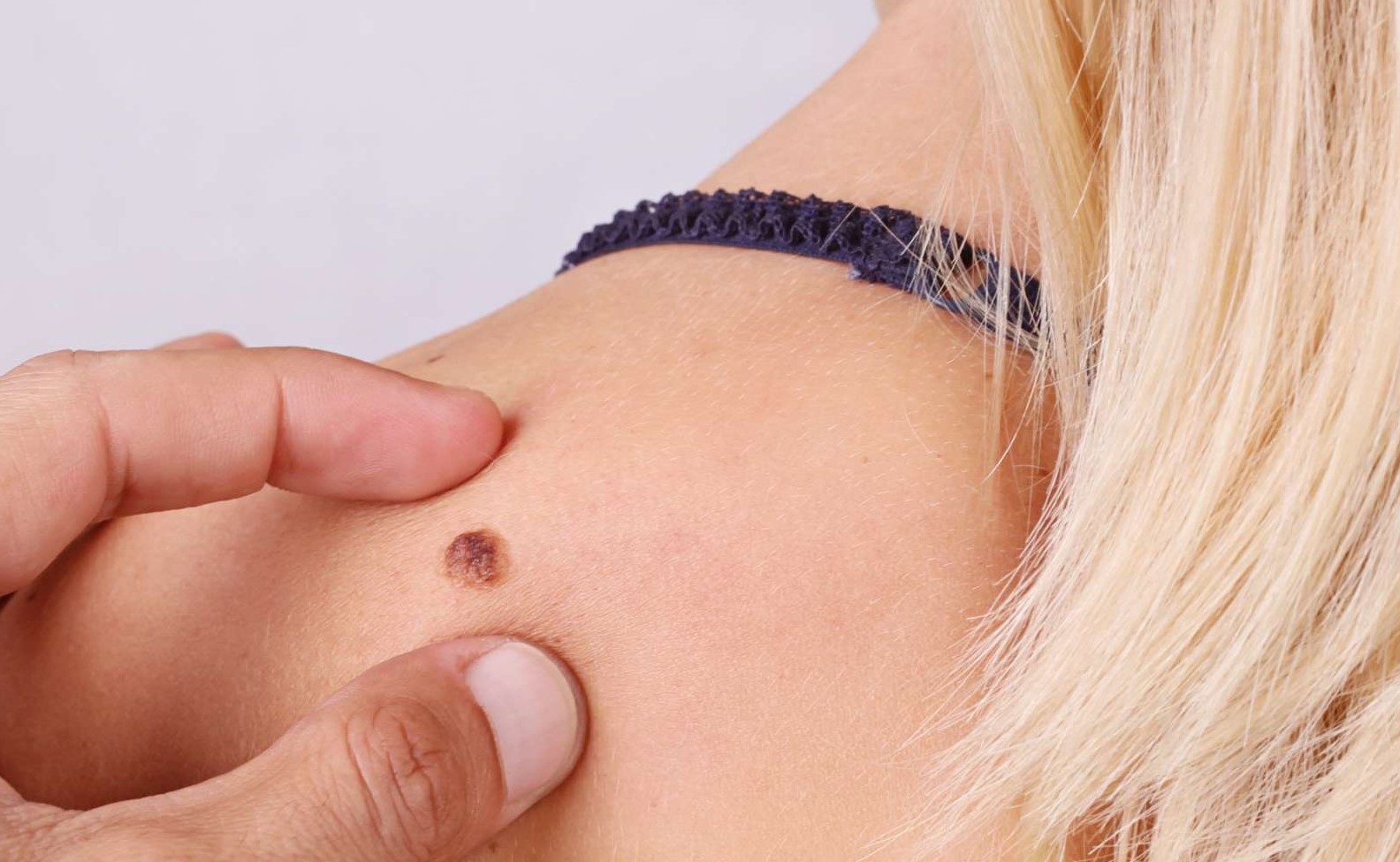 گوشت اضافه قهوه ای - انواع لکه های پوستی