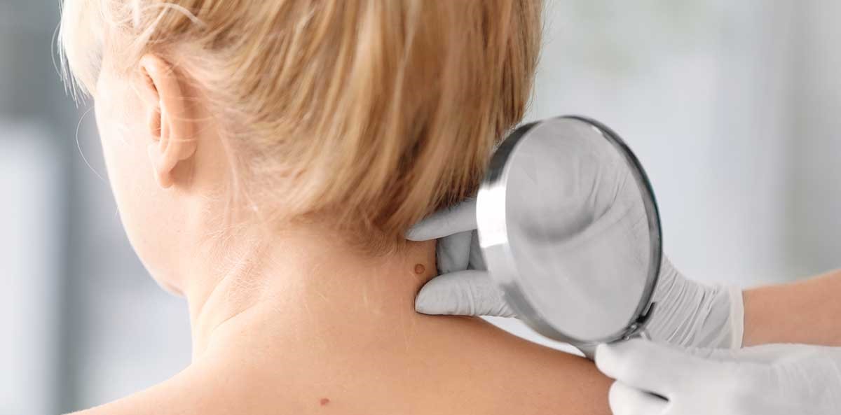 درمان زائده پوستی - زائده گوشتی روی پوست