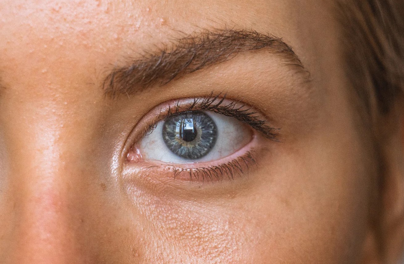 تیرگی زیر چشم - رفع تیرگی زیر چشم