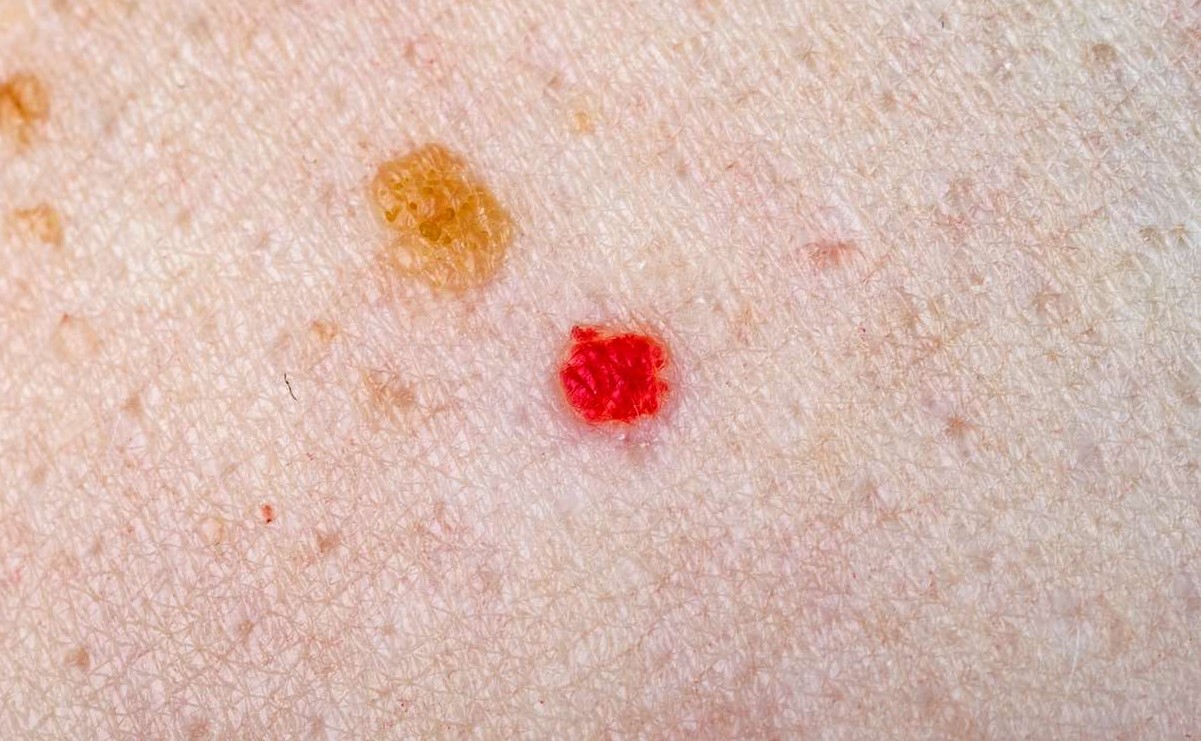 لکه های قرمز پوستی - انواع لکه های پوستی