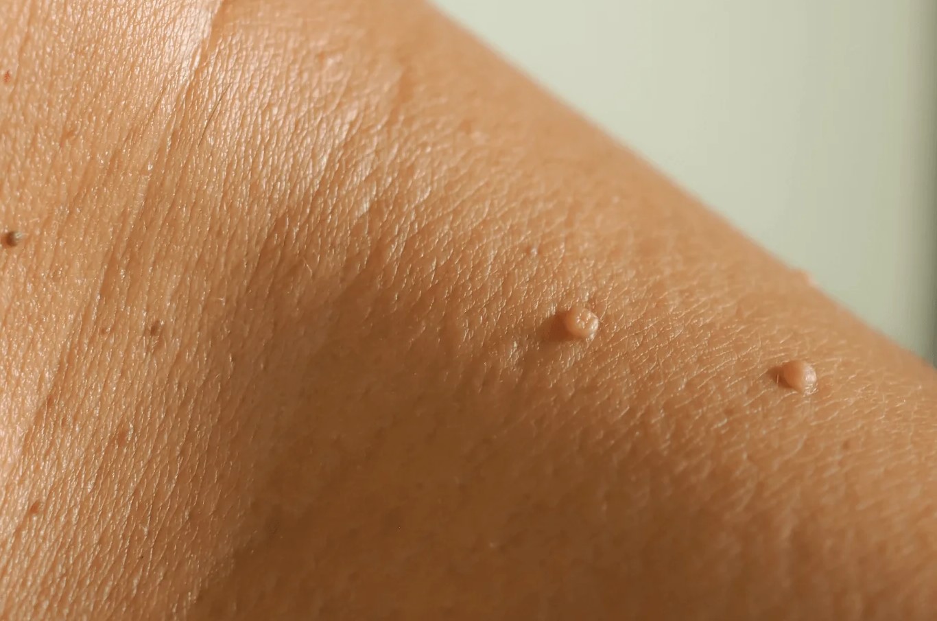 منگوله پوستی روی گردن - زائده گوشتی روی پوست