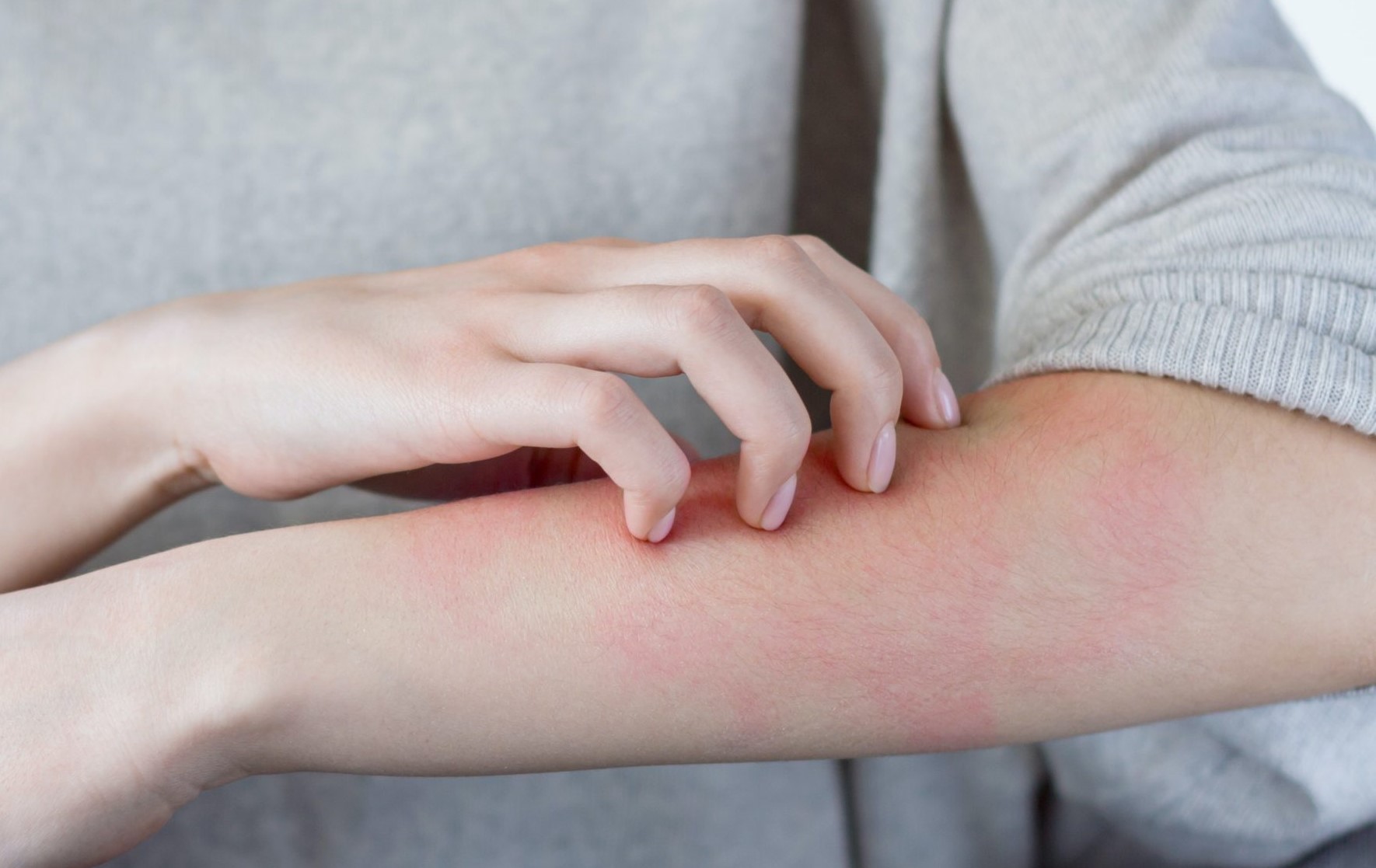 گزیدگی حشرات - انواع لکه های پوستی