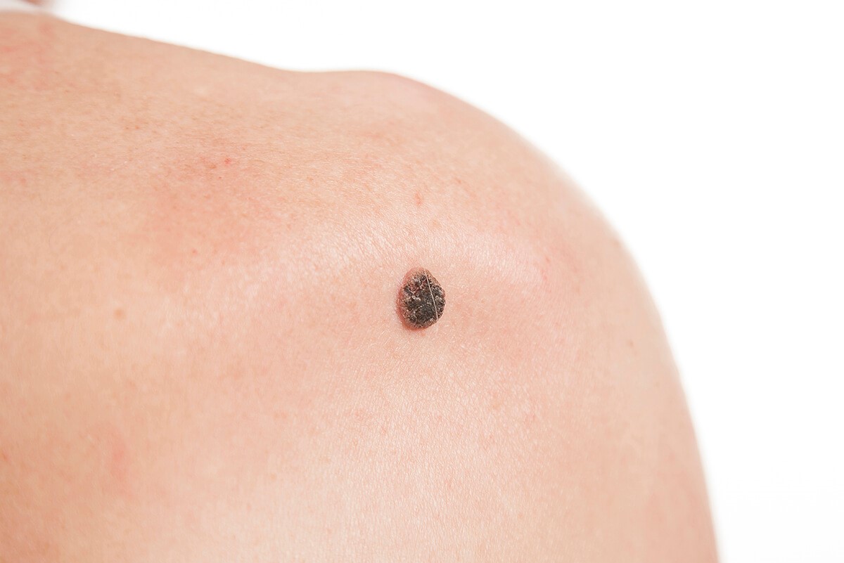 خال گوشتی روی بدن - زائده گوشتی روی پوست