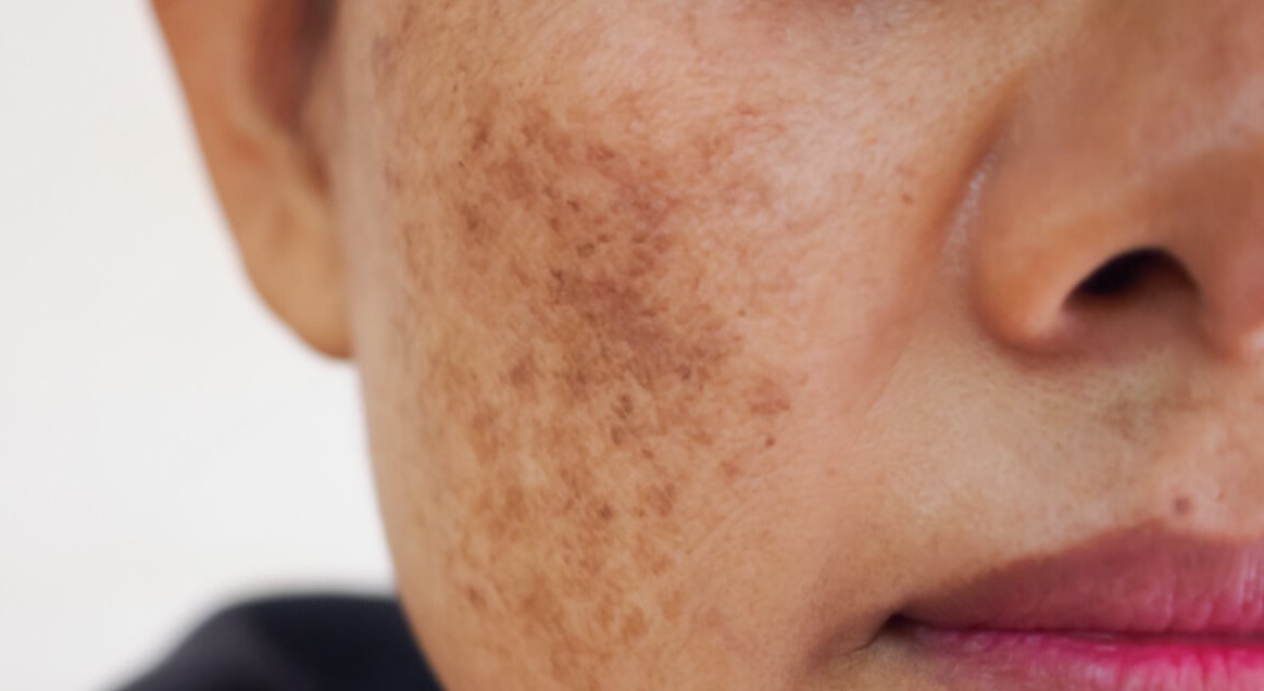 لک های قهوه ای پوست - انواع لکه های پوستی