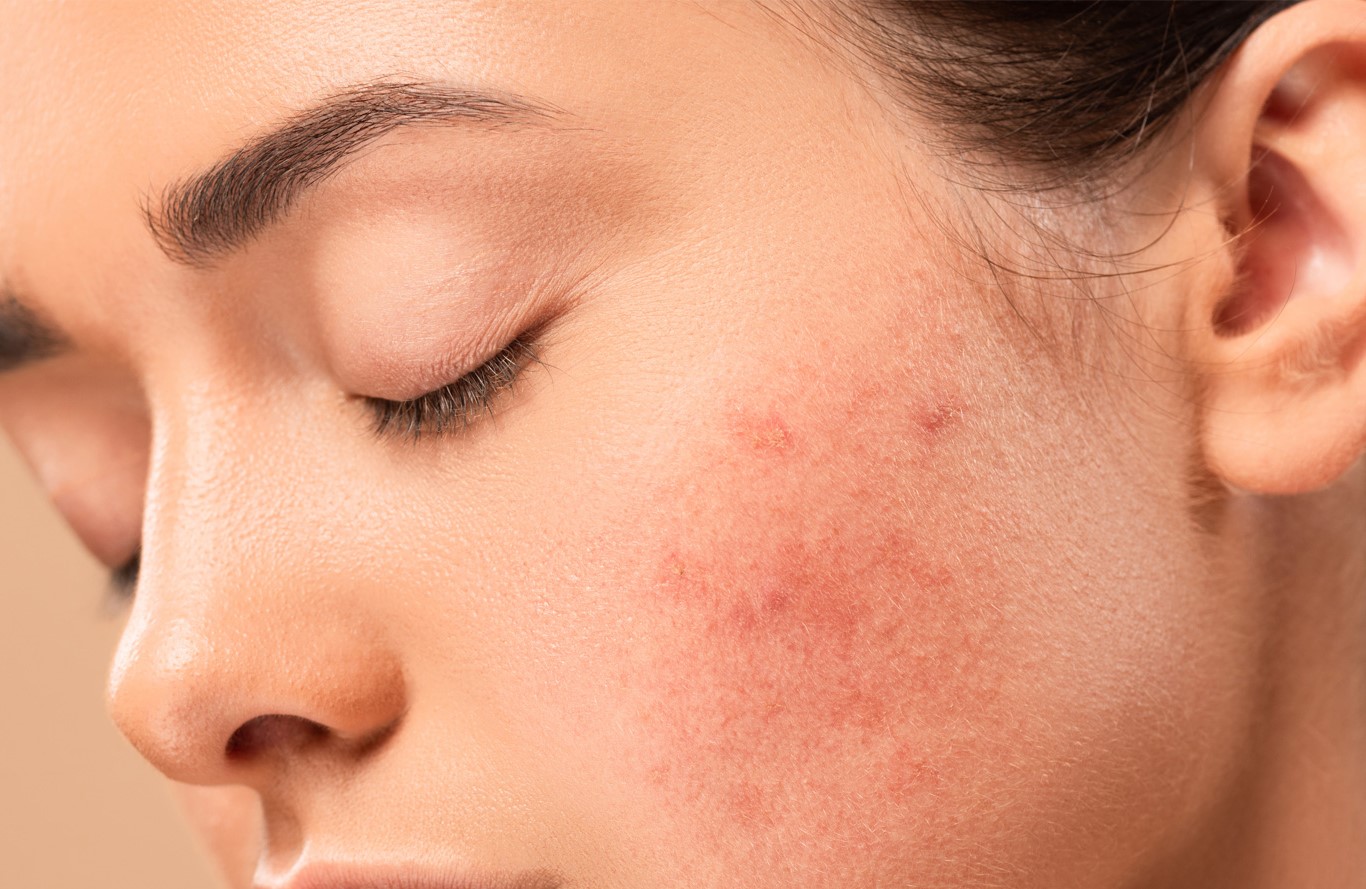 درمان جوش صورت - علت جوش در نواحی مختلف صورت