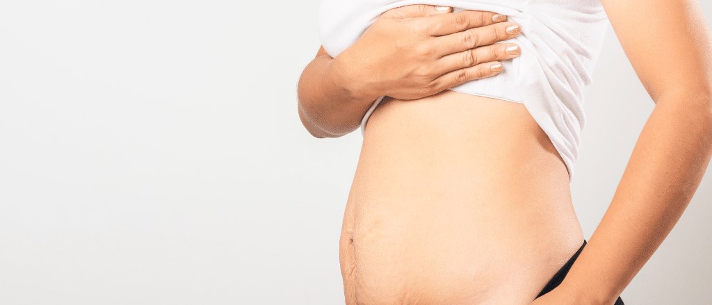 عوارض رژیم های سخت - درمان افتادگی پوست بعد از لاغری