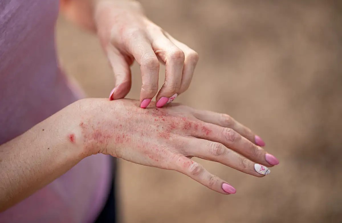 درمان پسوریازیس - قاتل پسوریازیس