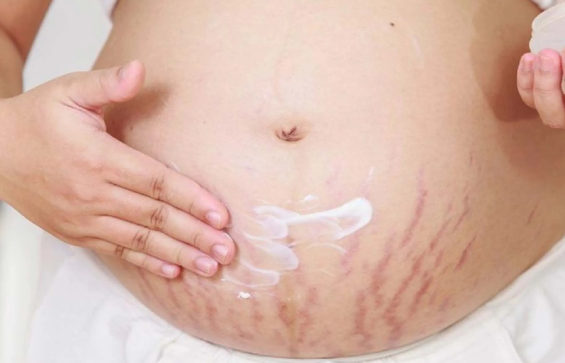 پیشگیری از ترک پوستی ناشی از بارداری - پیشگیری از ترک پوستی