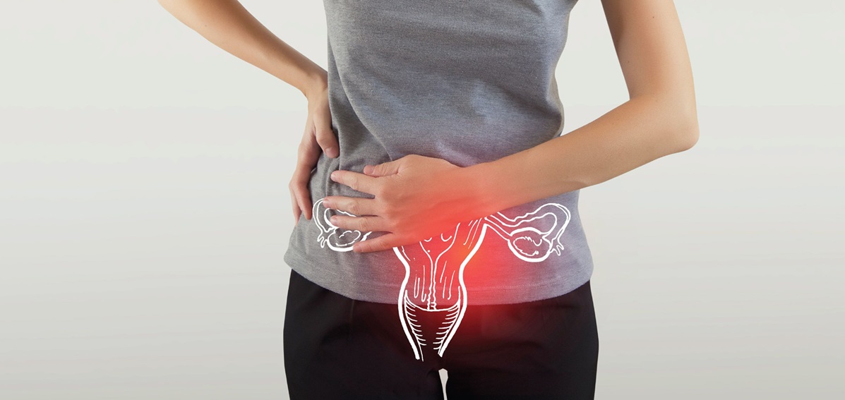 سندرم تخمدان - ریزش مو ناشی از سندرم تخمدان