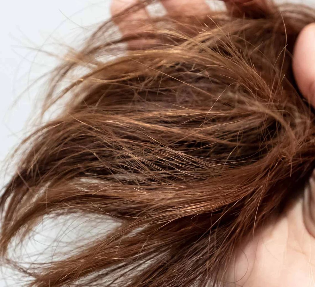 درمان موخوره - بهترین ماسک مو برای درمان موخوره