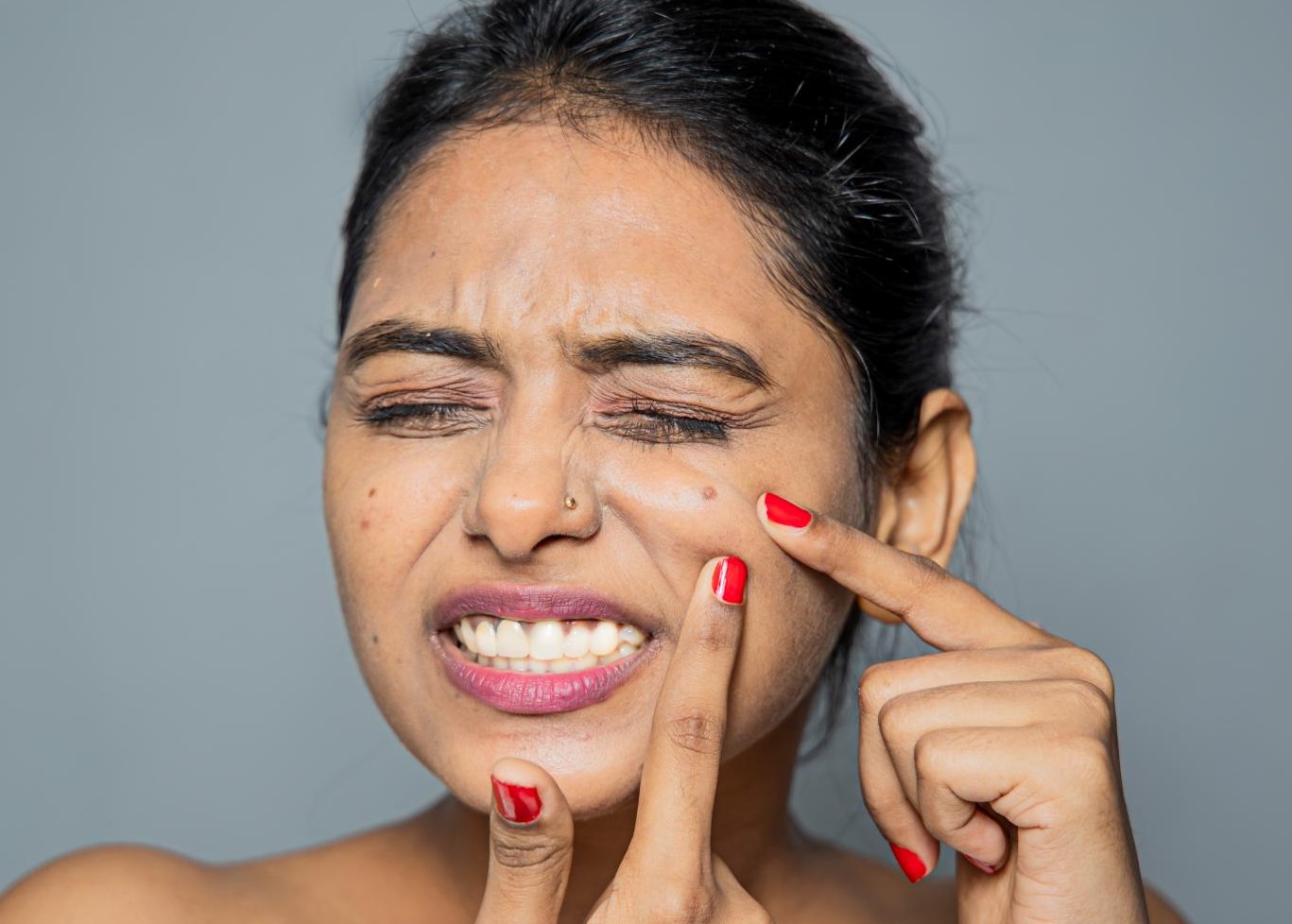 علت جوش روی گونه - علت جوش در نواحی مختلف صورت