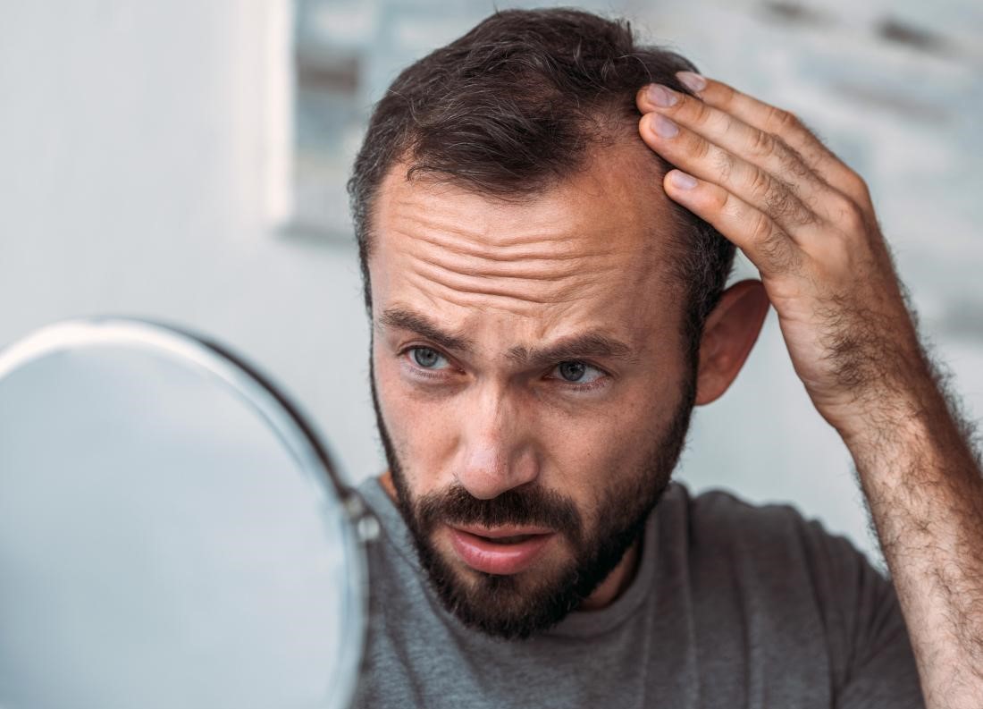 ریزش موی مردان - رفع دائمی چربی پوست سر