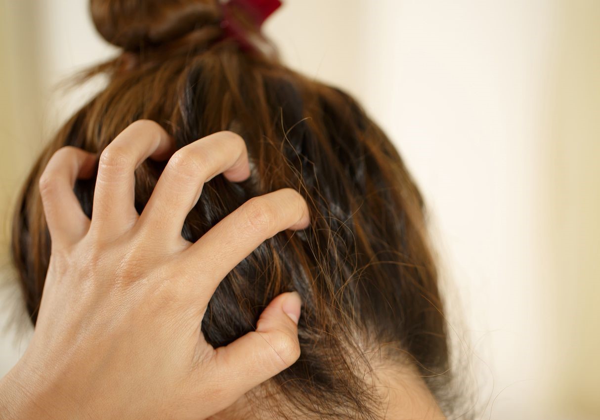 چربی کف سر - رفع دائمی چربی پوست سر