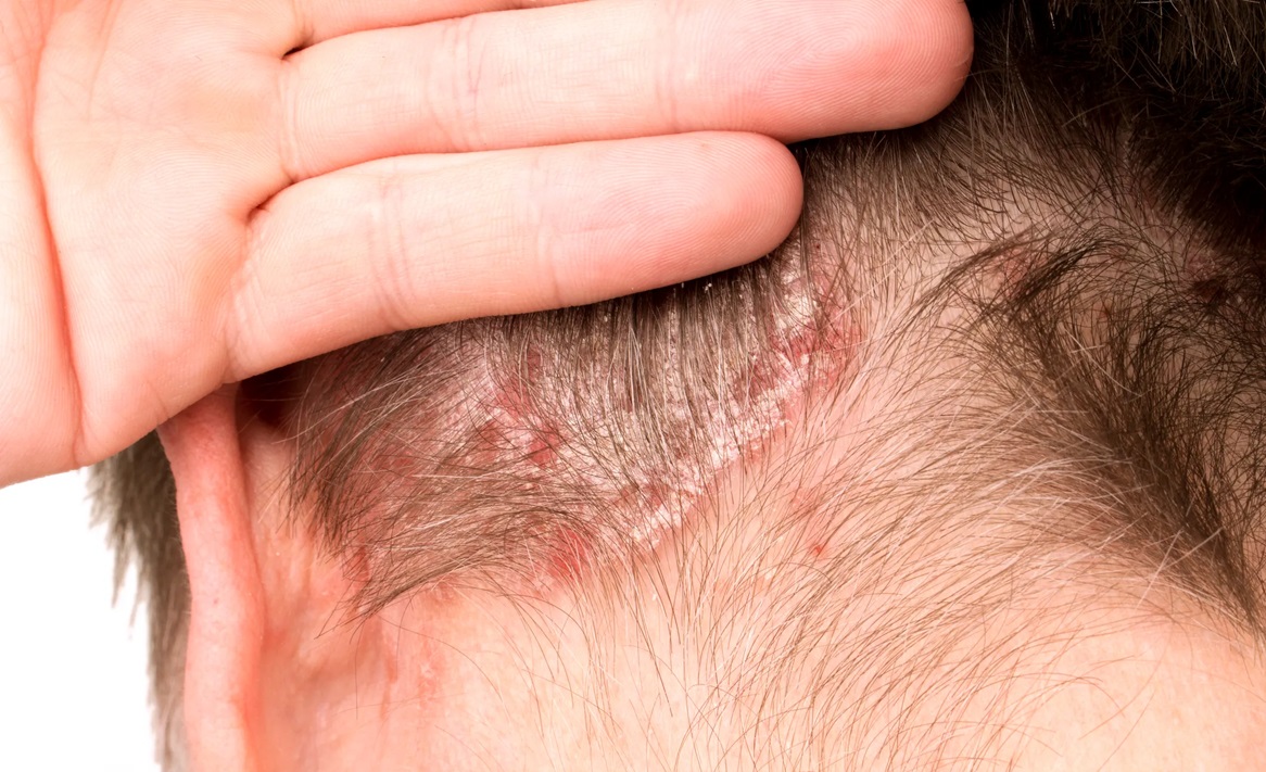 پسوریازیس پوست سر - قاتل پسوریازیس