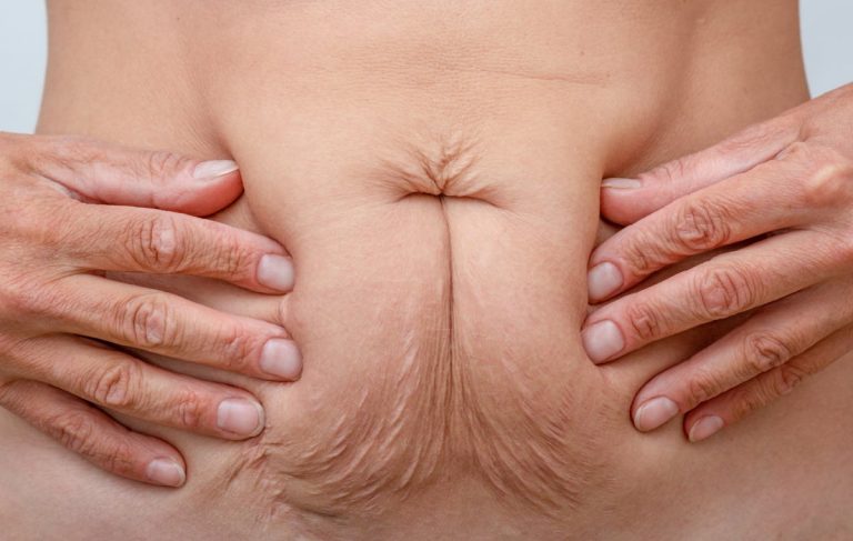 درمان افتادگی پوست بعد از لاغری