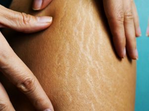 پیشگیری از ترک پوستی