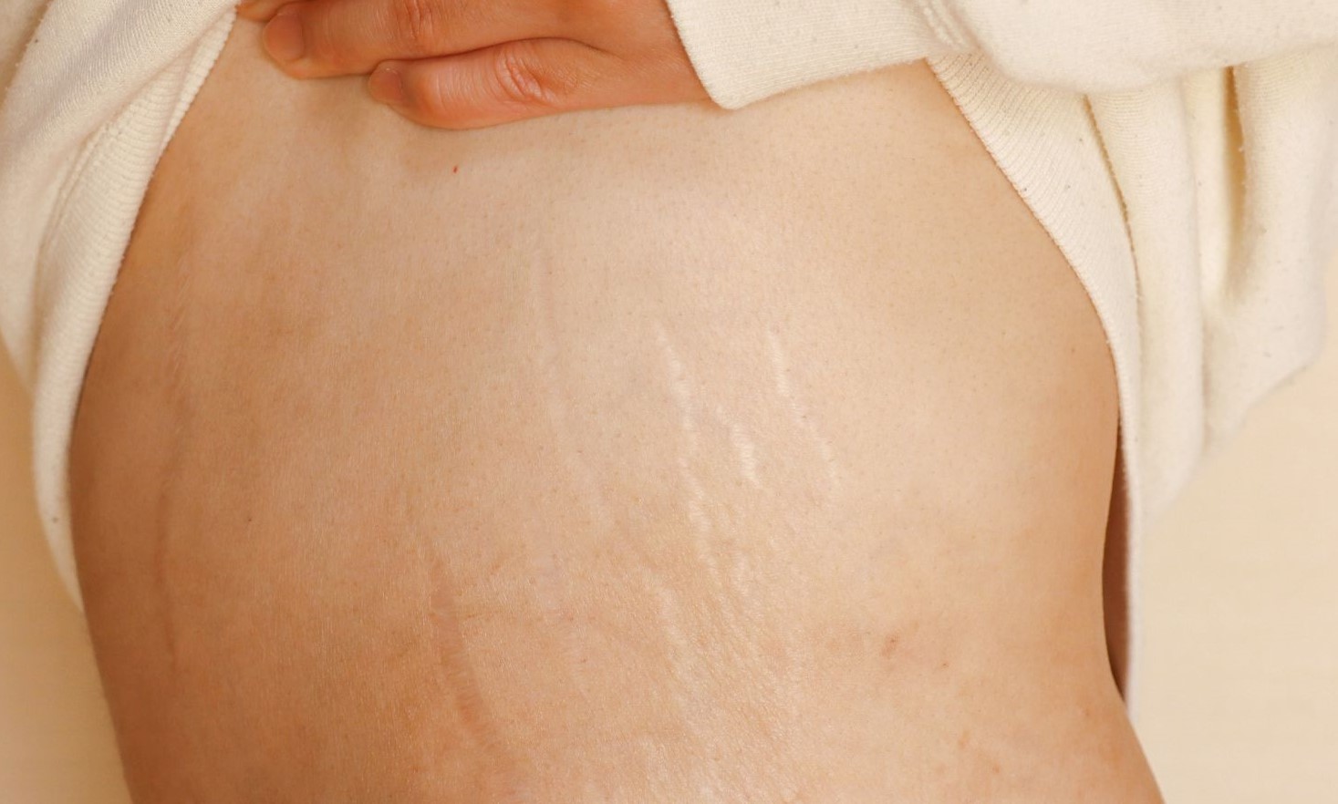 ترک پوستی - پیشگیری از ترک پوستی