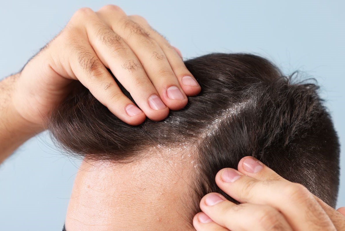 شوره سر - رفع دائمی چربی پوست سر