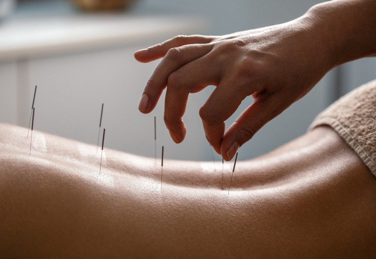 خواص طب سنتی - لاغری با طب سوزنی