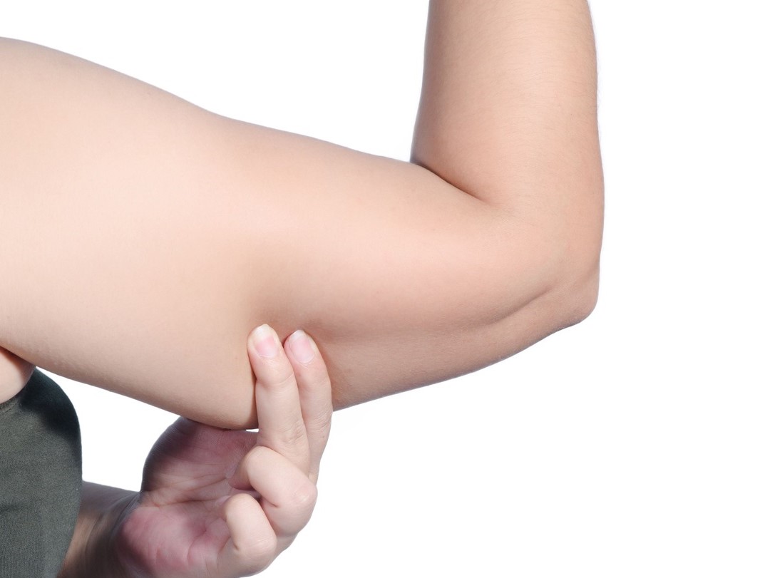 رفع شلی پوست - شل شدن پوست بعد از لاغری