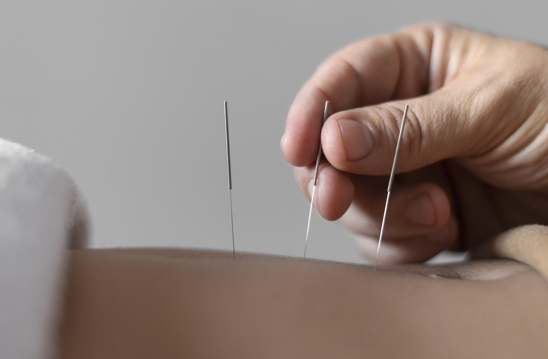 طب سوزنی برای لاغری - لاغری با طب سوزنی