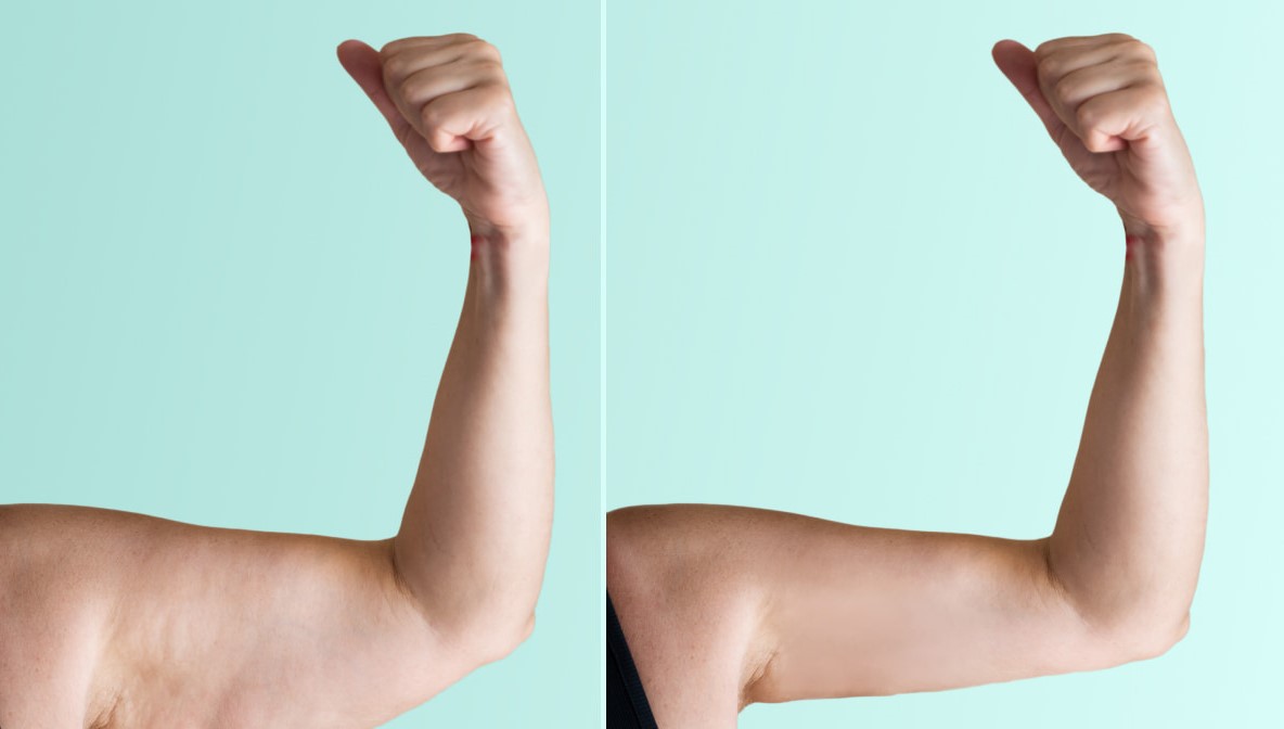 لاغر کردن بازو - لاغری سریع بازو در یک هفته
