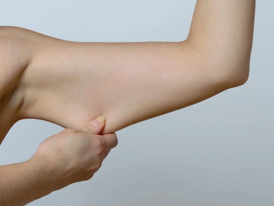 شل شدن بازو - شل شدن پوست بعد از لاغری