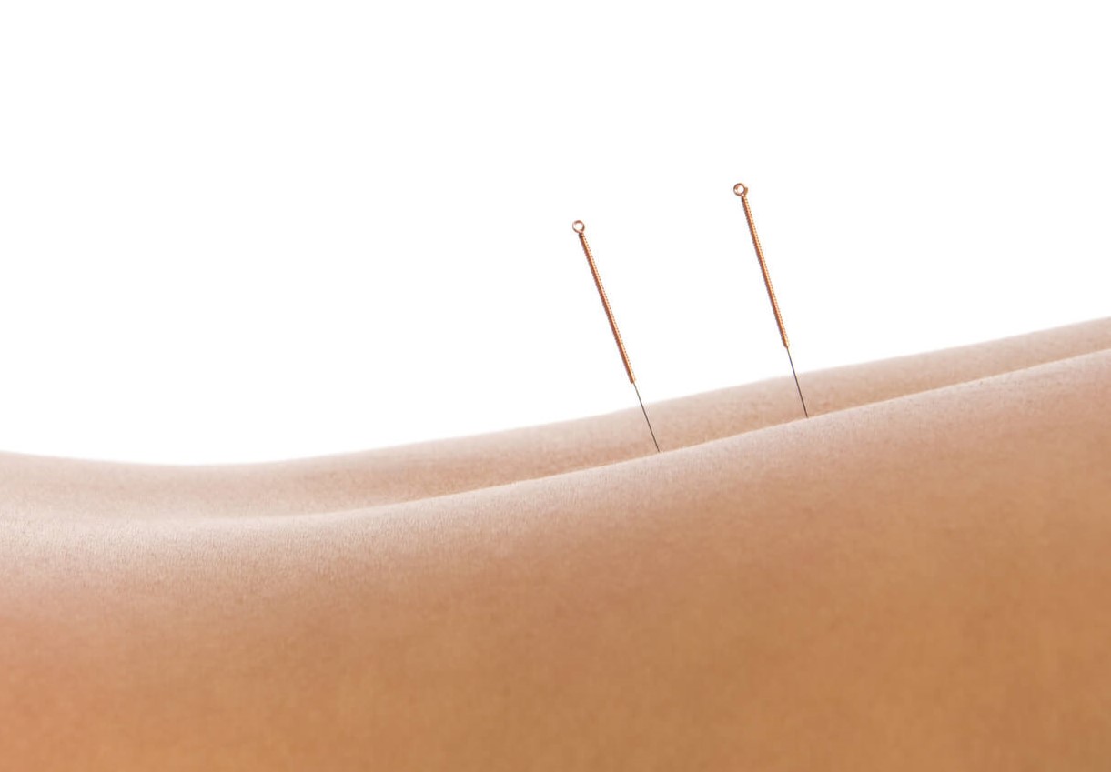 فواید لاغری با طب سوزنی