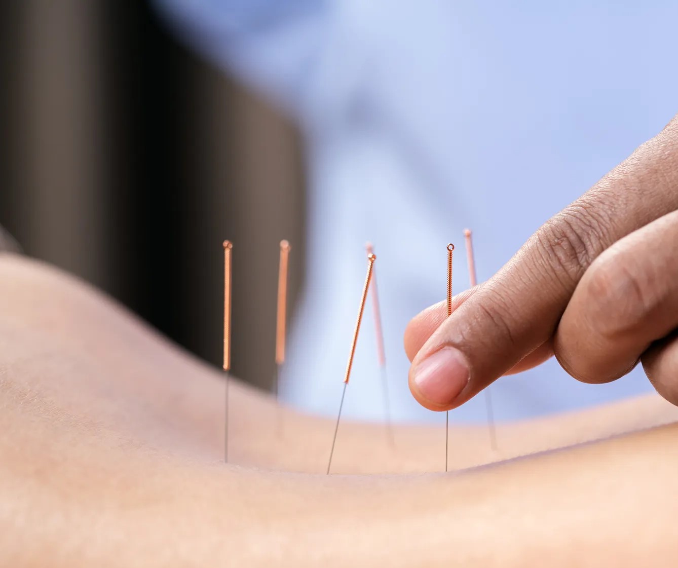 لاغری موضعی - لاغری با طب سوزنی