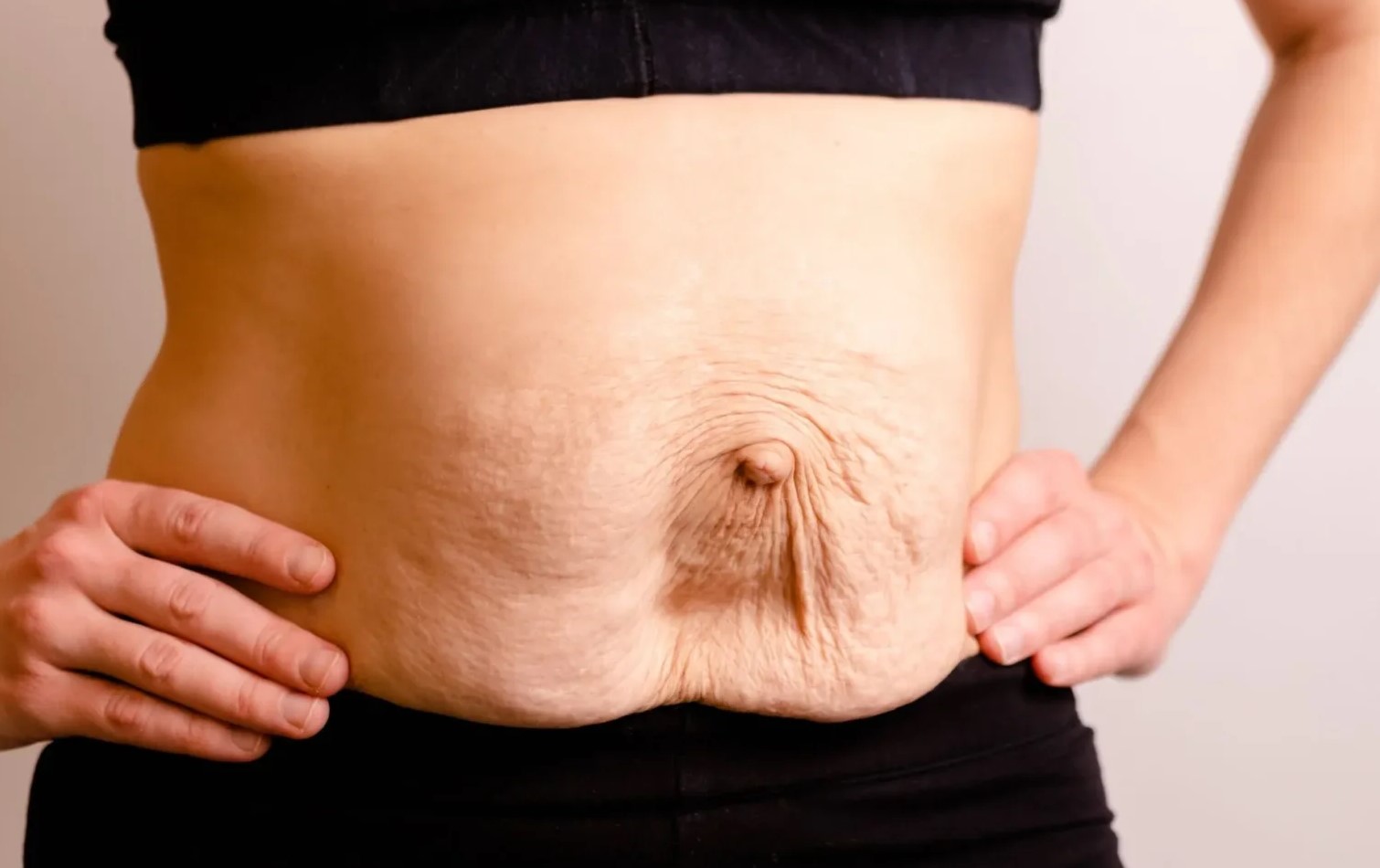 افتادگی پوست شکم - شل شدن پوست بعد از لاغری