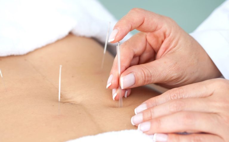 لاغری با طب سوزنی