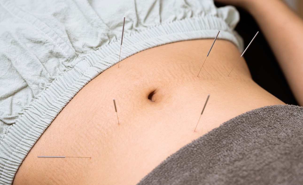 طب سوزنی برای لاغری - لاغری با طب سوزنی